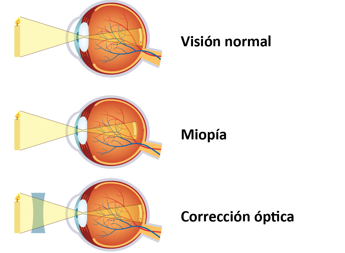 Tabla comparativa Miopia