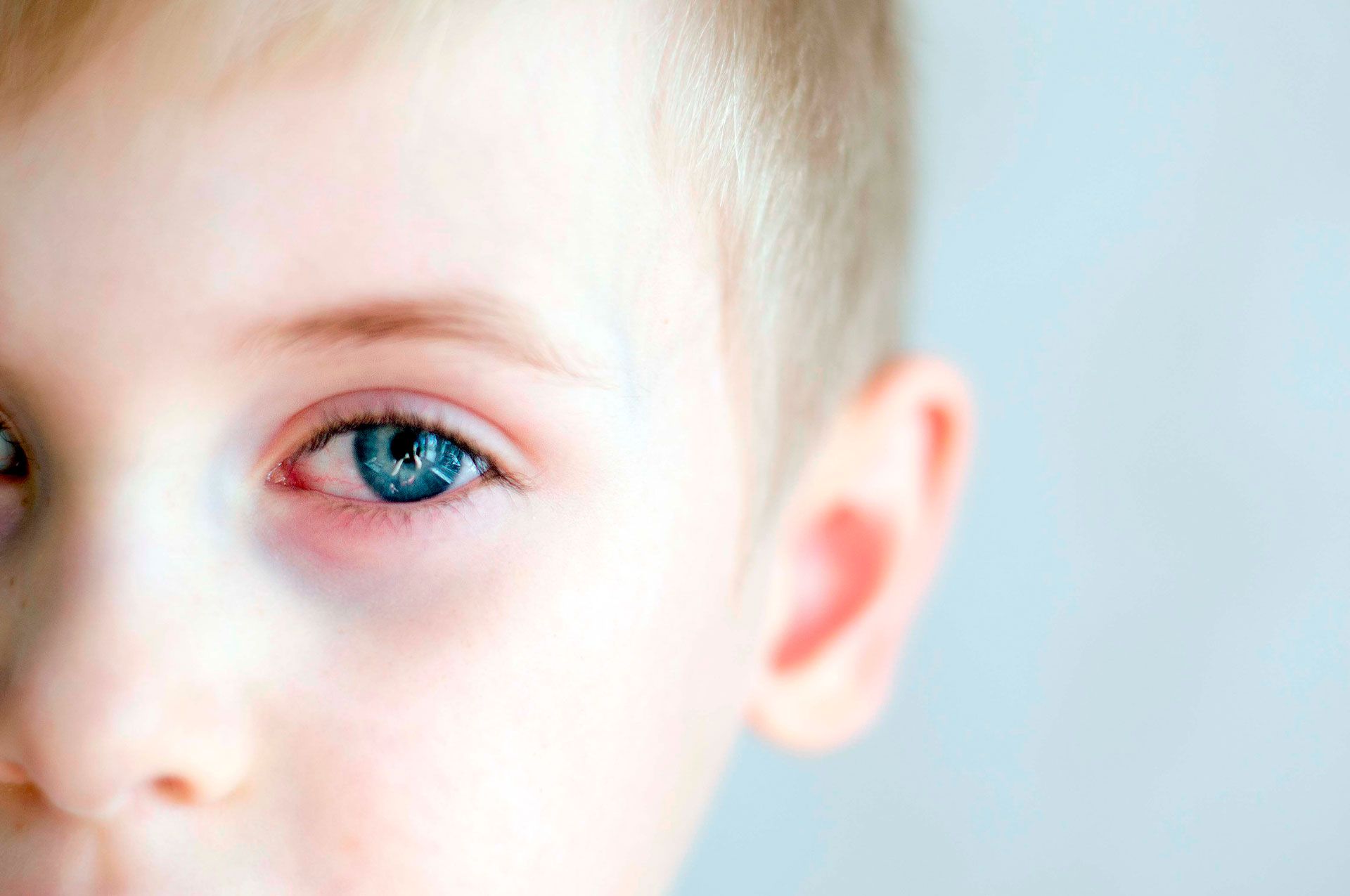 Niño con alergia ocular