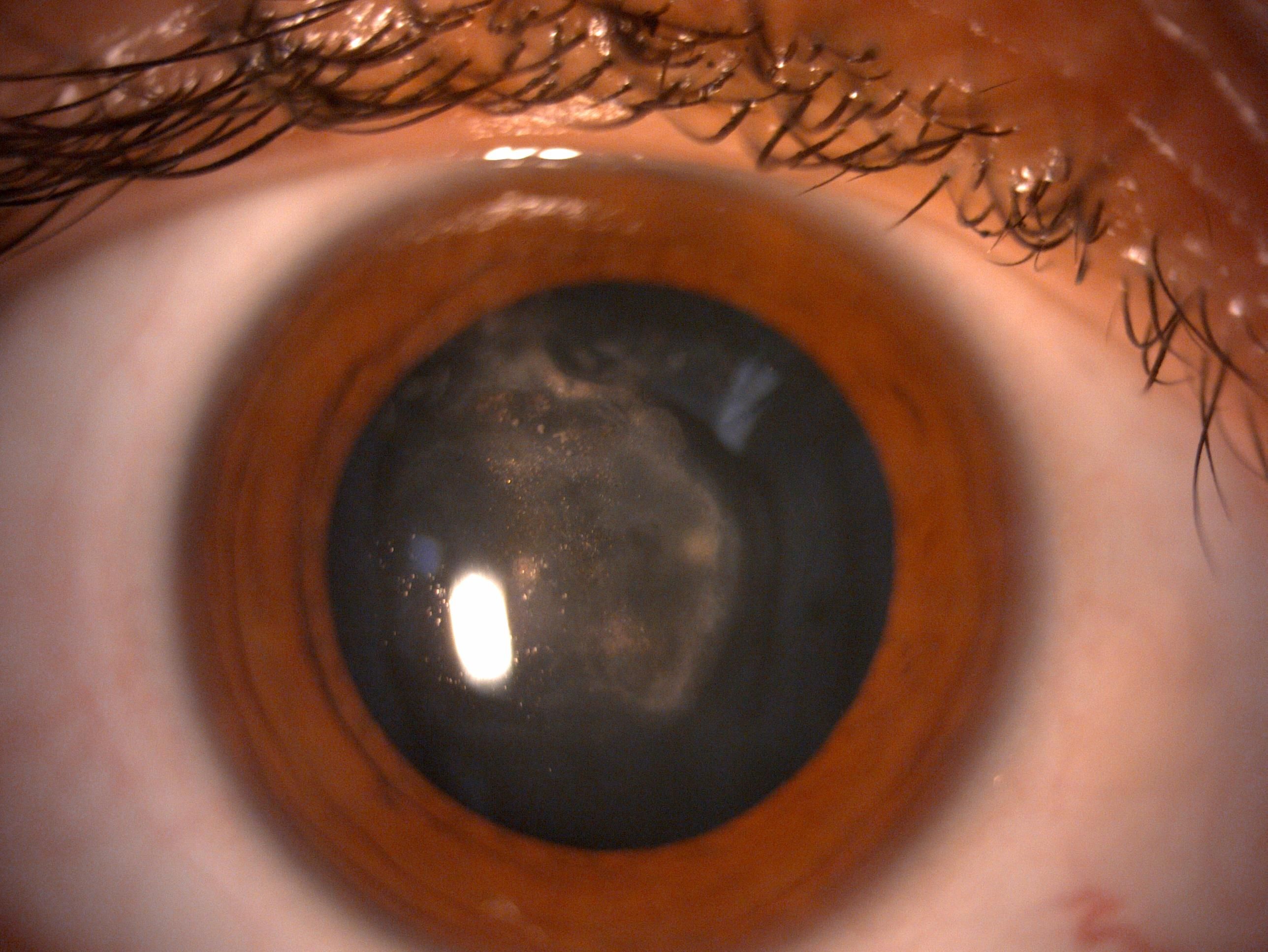 Ojo de un paciente con cicartriz corneal