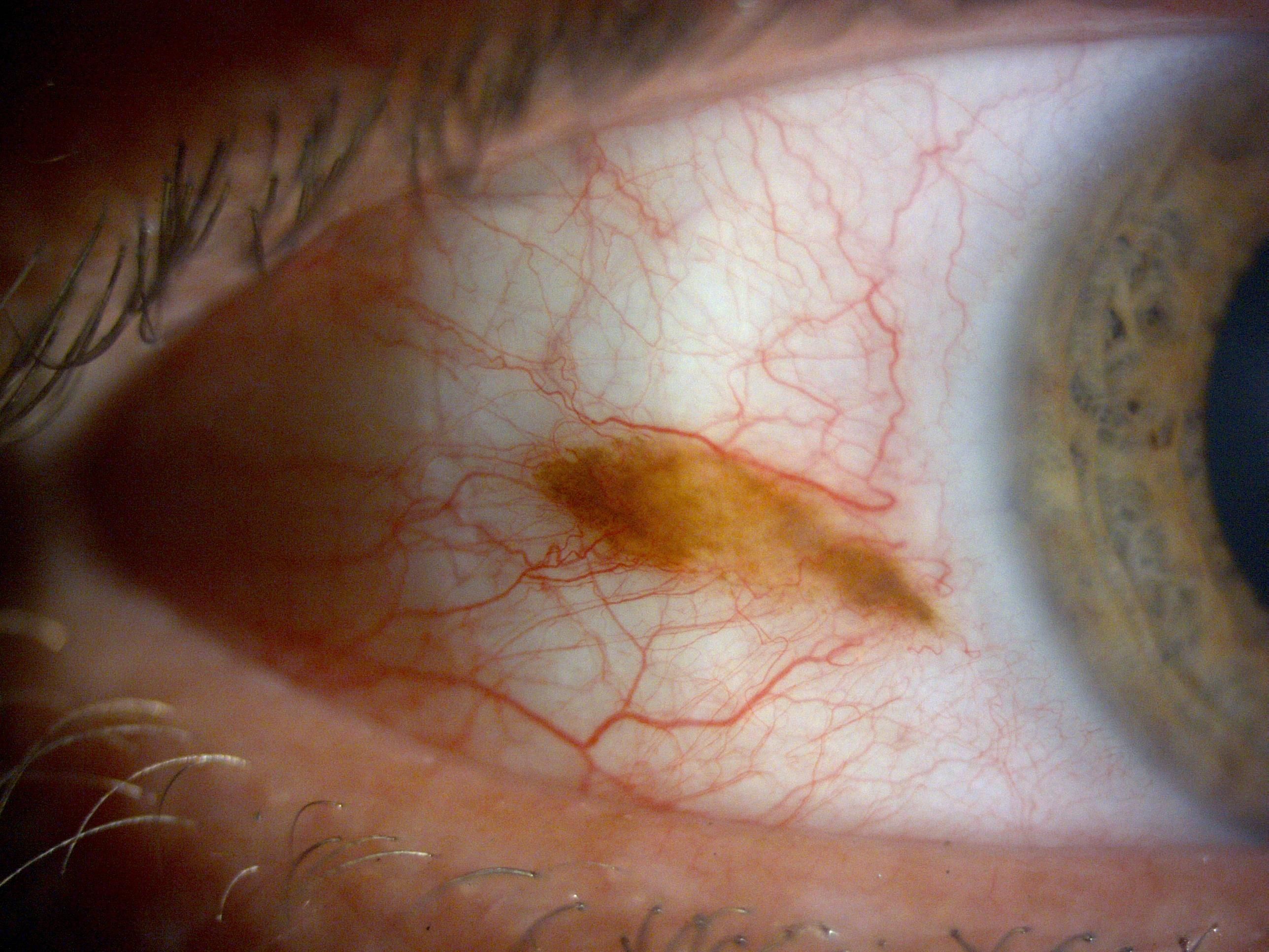 Tumor ocular que afecta a la esclerótica