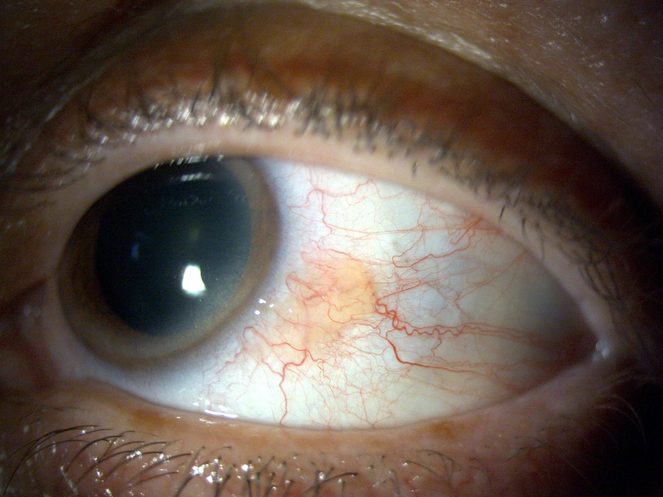 Paciente con tumor ocular