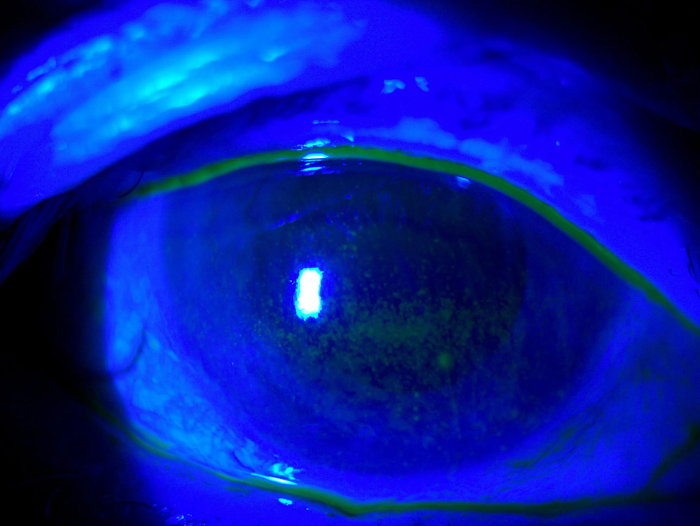 Queratoconjuntivitis por ojo seco